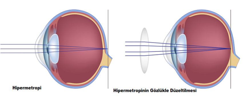 Hipermetropi Nedir?