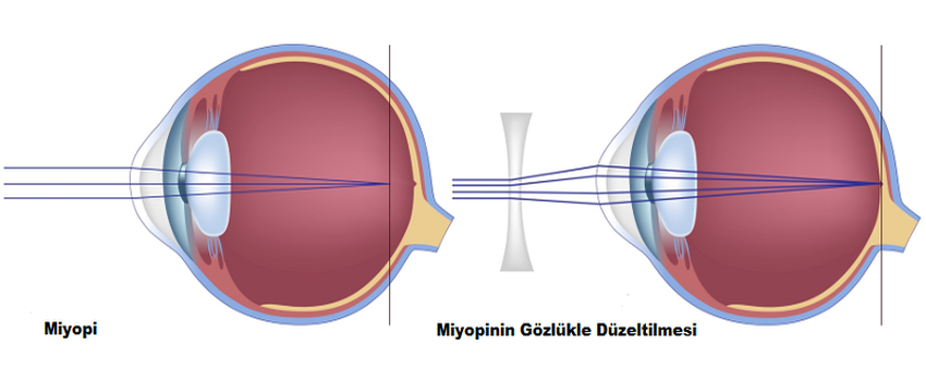 Miyopi Nedir?