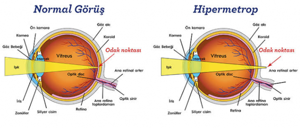 HİPERMETROPLAR İLE MİYOPLAR NASIL GÖRÜR?